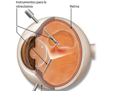 Ilustración cirugía desprendimiento de retina